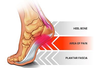 pain in heel sole